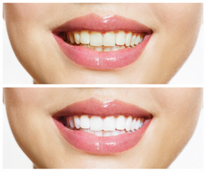 Teeth whitening should only be performed by dentists