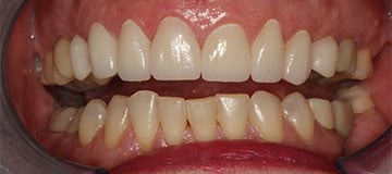 Closeup of a female's smile showing shortened teeth and an uneven smile