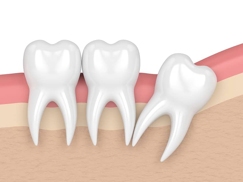 illustration of impacted wisdom teeth