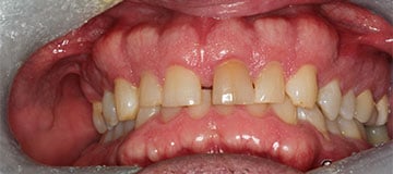 Male's teeth before dental work provided by Dr. Adam Hahn
