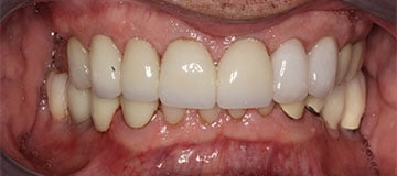 Discolored teeth shown as a closeup