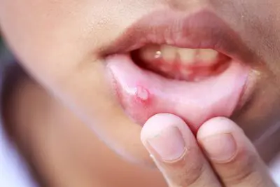 young woman showing a canker sore on her lower lip