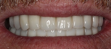 Closeup of a man's smile after treatment with Dr Hahn
