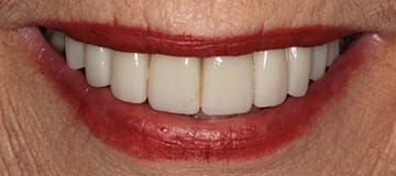 Beautiful new teeth after a smile makeover