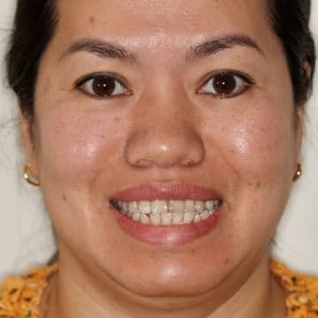 Quynh full face before treatment