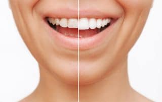 image of before and after veneers
