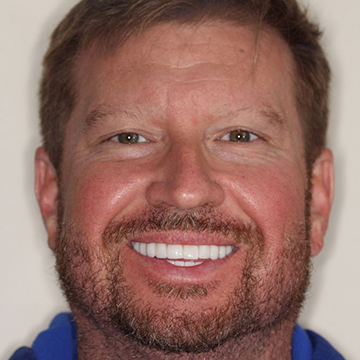 Patient full face after full mouth reconstruction at Dr. Hahn's office.